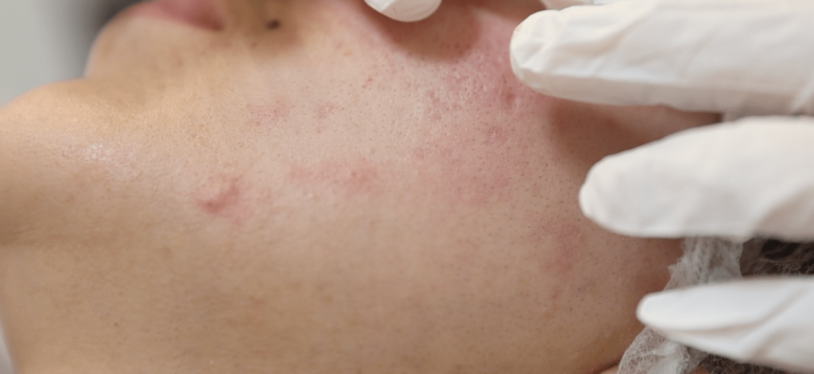 HOE HERKEN JE EEN ACNE GEVOELIGE HUID?